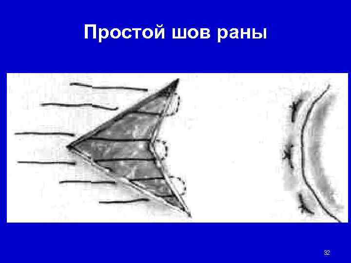 Простой шов раны    32 