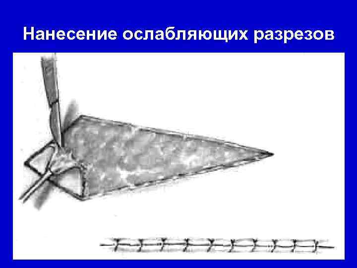 Нанесение ослабляющих разрезов       33 