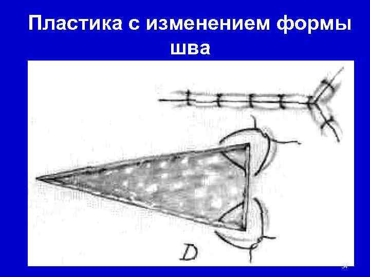 Пластика с изменением формы   шва      34 