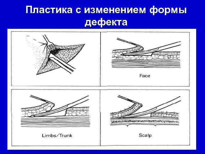 Пластика с изменением формы  дефекта      36 