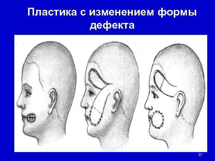 Пластика с изменением формы  дефекта      37 