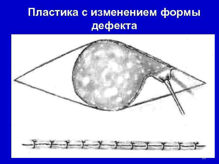 Пластика с изменением формы  дефекта      38 