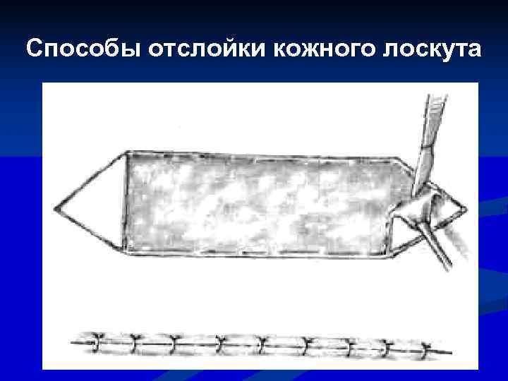 Способы отслойки кожного лоскута      41 