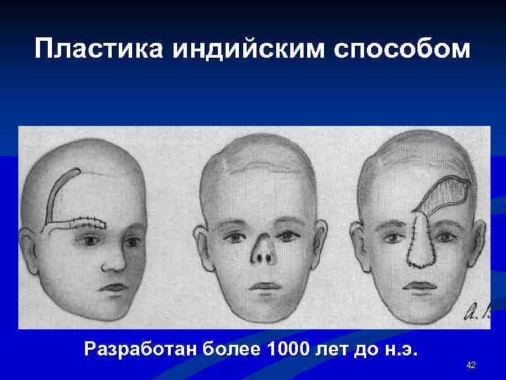 Пластика индийским способом  Разработан более 1000 лет до н. э.   