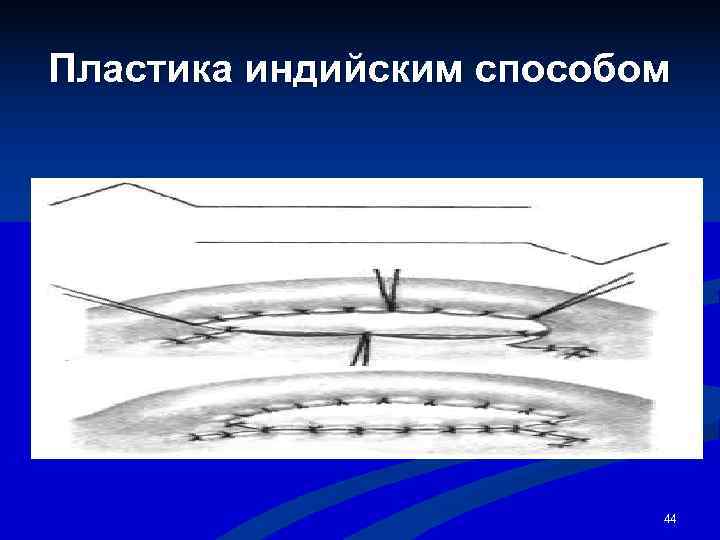 Пластика индийским способом      44 