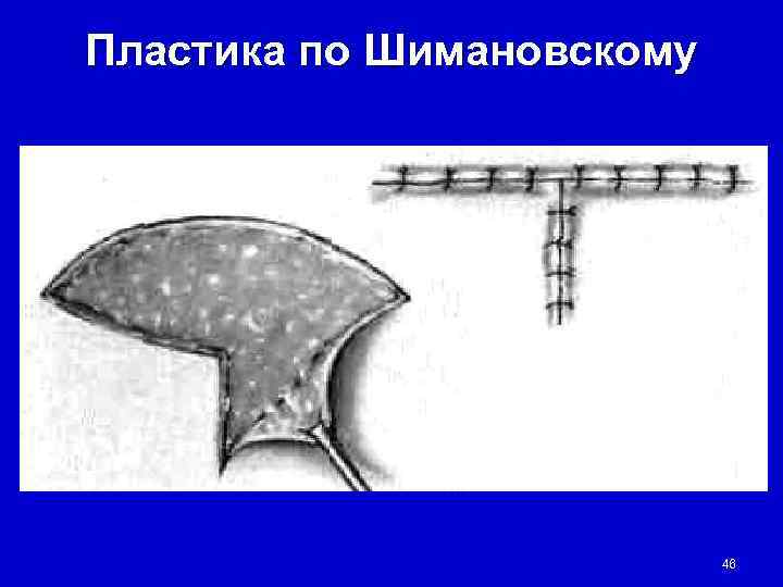 Пластика по Шимановскому      46 