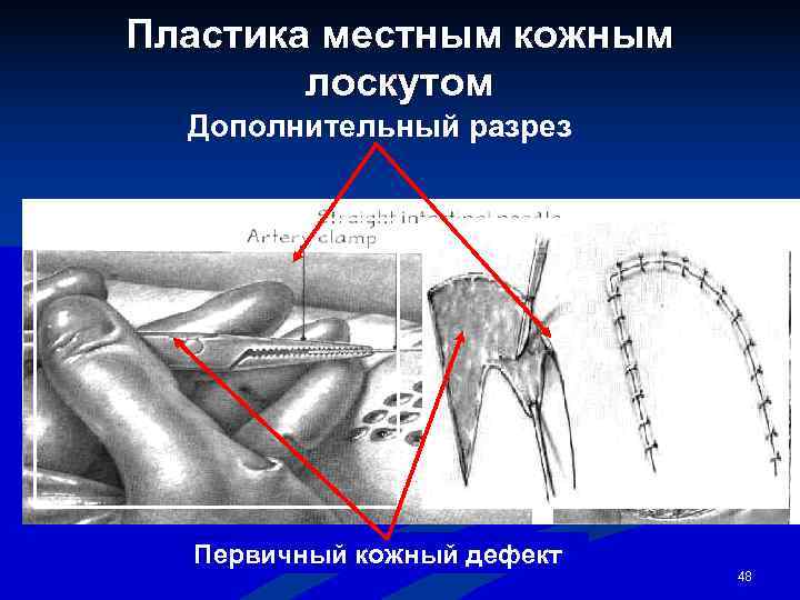 Пластика местным кожным   лоскутом  Дополнительный разрез  Первичный кожный дефект 