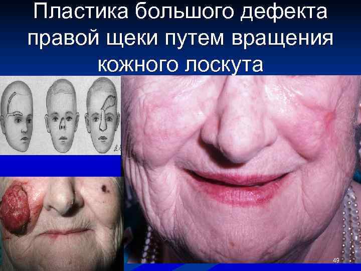 Пластика большого дефекта правой щеки путем вращения  кожного лоскута    
