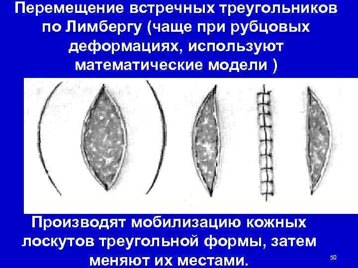 Перемещение встречных треугольников  по Лимбергу (чаще при рубцовых  деформациях, используют  математические