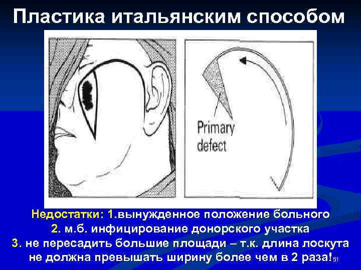 Пластика итальянским способом   Недостатки: 1. вынужденное положение больного  2. м. б.