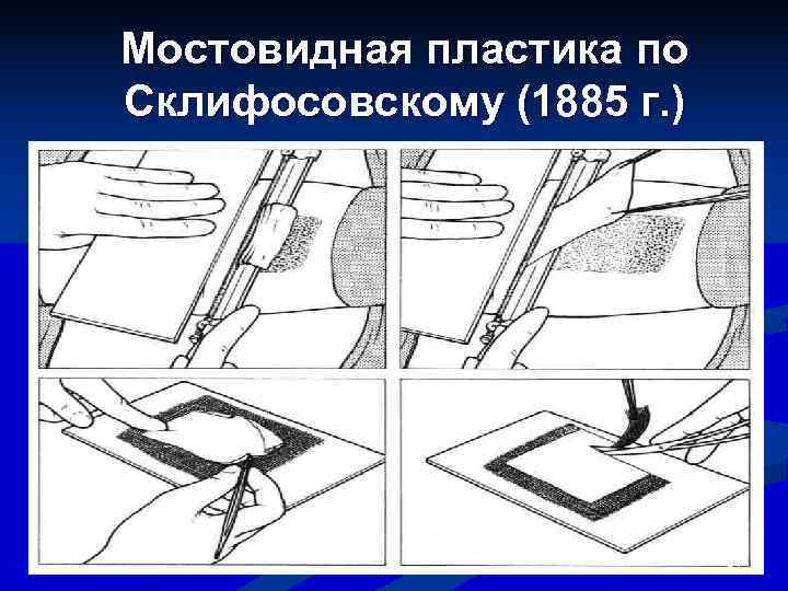 Мостовидная пластика по Склифосовскому (1885 г. )      52 