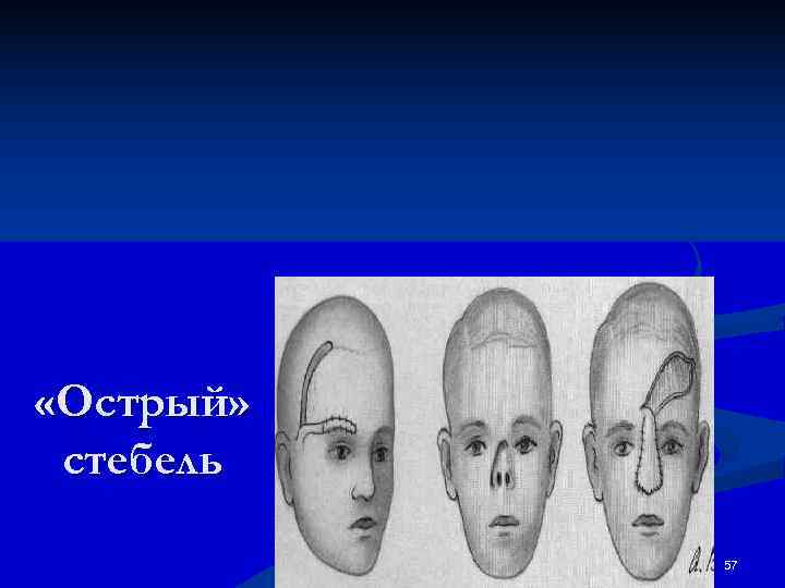  «Острый»  стебель   57 