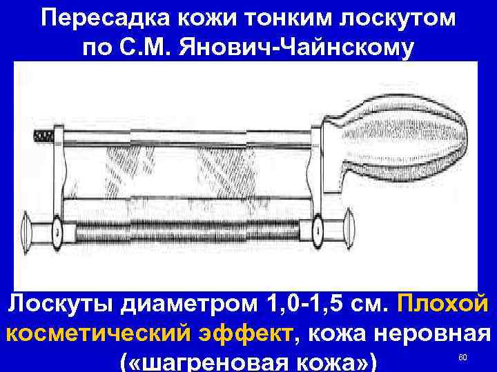  Пересадка кожи тонким лоскутом по С. М. Янович-Чайнскому Лоскуты диаметром 1, 0 -1,
