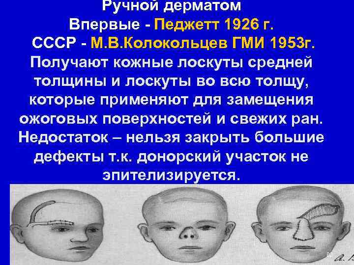    Ручной дерматом  Впервые - Педжетт 1926 г.  СССР -