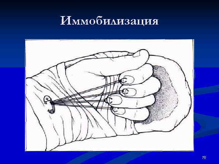 Иммобилизация     78 