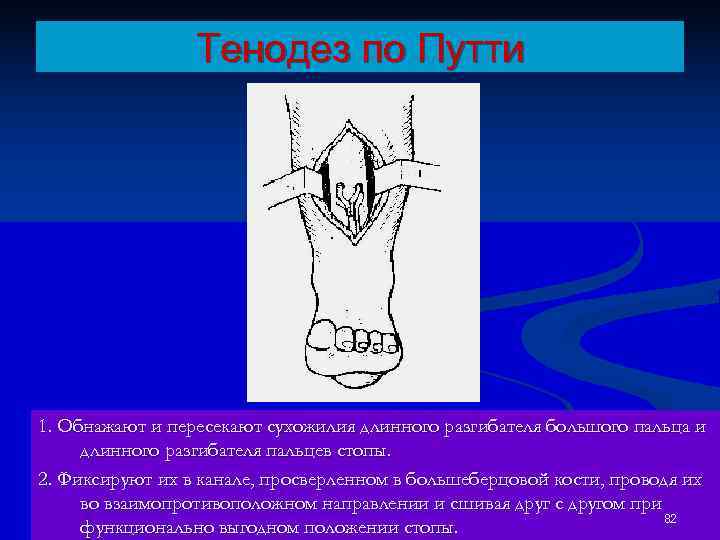    Тенодез по Путти 1. Обнажают и пересекают сухожилия длинного разгибателя большого