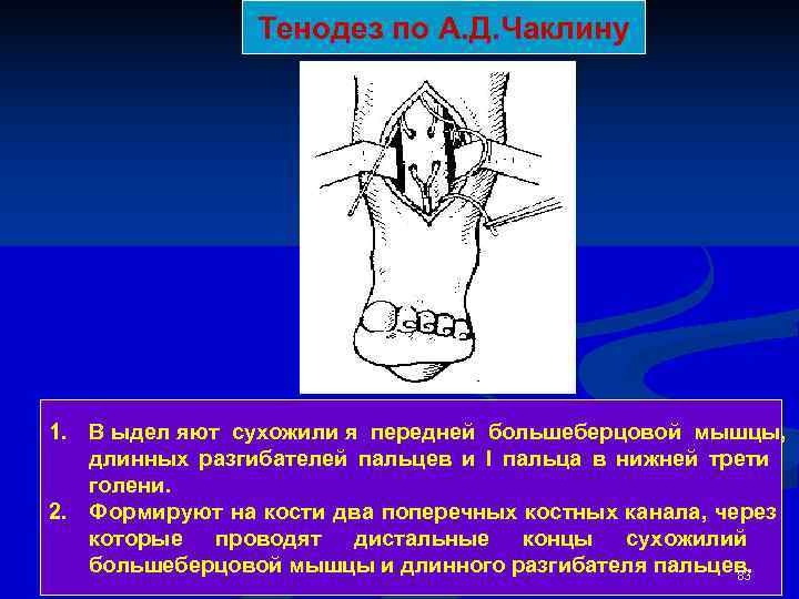     Тенодез по А. Д. Чаклину 1. В ыдел яют сухожили