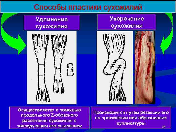 Пластика сухожилий