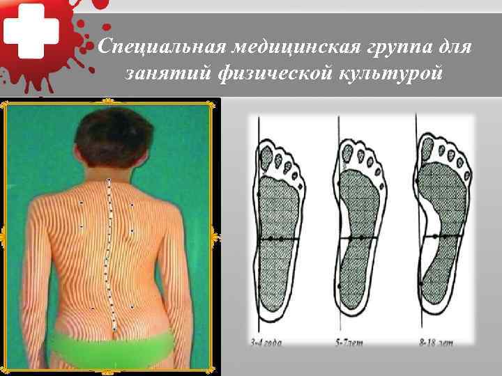     Специальная подгруппа «А»    (III группа) : 1)