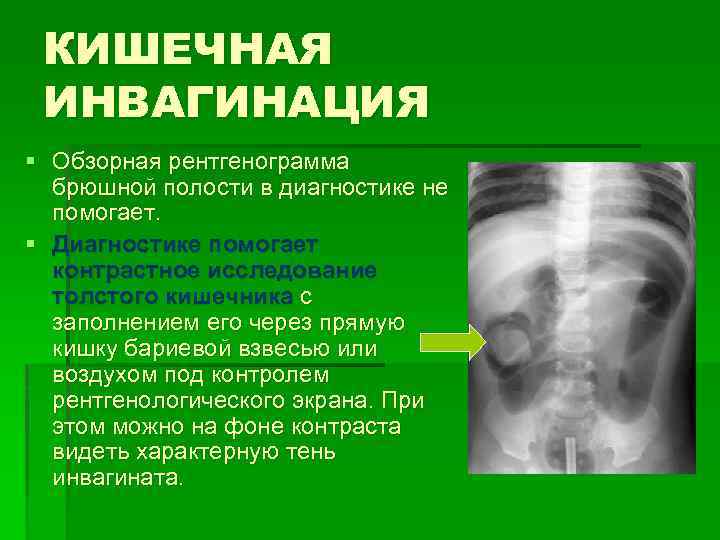 КИШЕЧНАЯ ИНВАГИНАЦИЯ § Обзорная рентгенограмма брюшной полости в диагностике не помогает. § Диагностике помогает