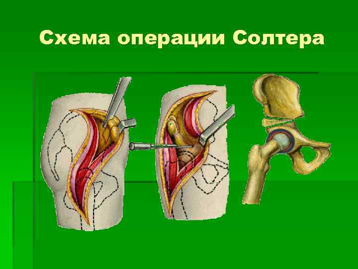 Схема операции Солтера 