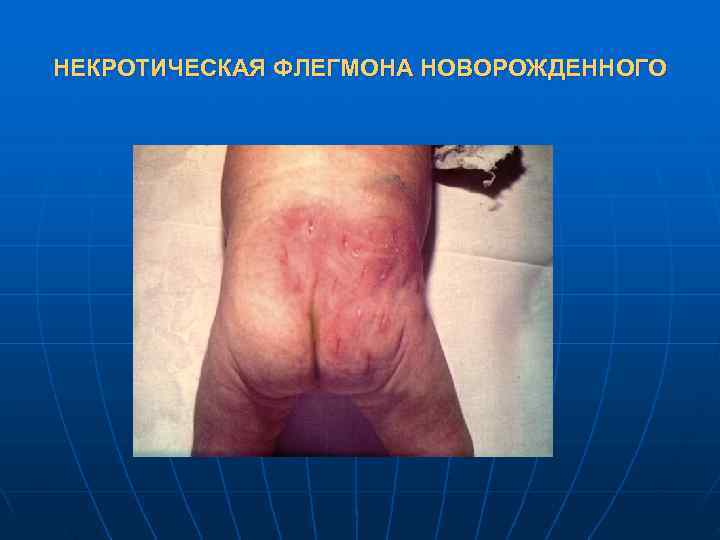 НЕКРОТИЧЕСКАЯ ФЛЕГМОНА НОВОРОЖДЕННОГО 