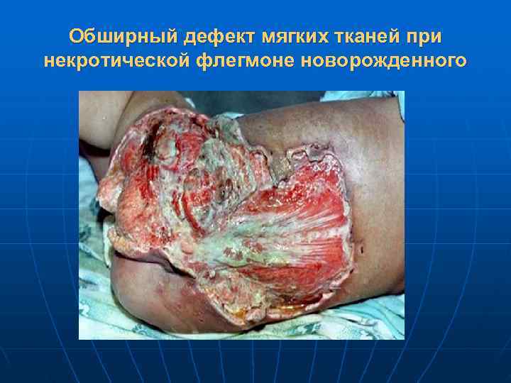  Обширный дефект мягких тканей при некротической флегмоне новорожденного 