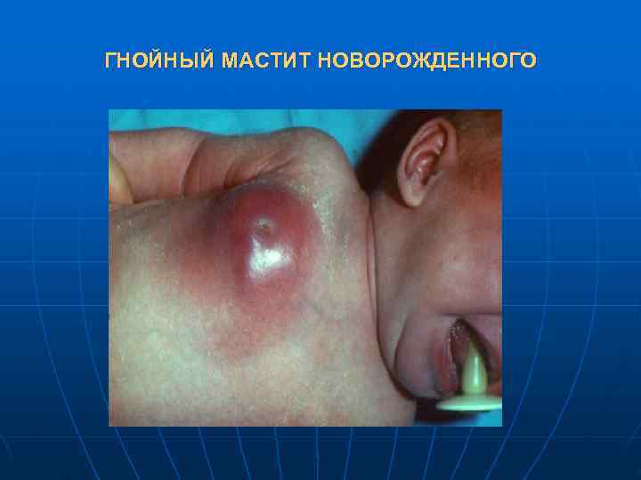 ГНОЙНЫЙ МАСТИТ НОВОРОЖДЕННОГО 