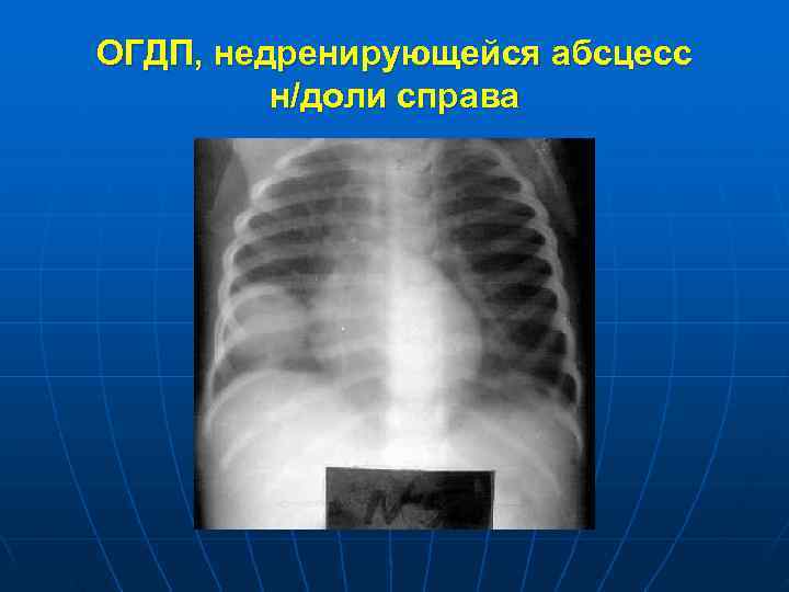 ОГДП, недренирующейся абсцесс   н/доли справа 