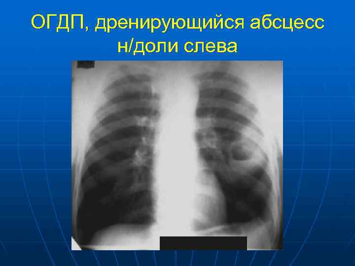 ОГДП, дренирующийся абсцесс   н/доли слева 