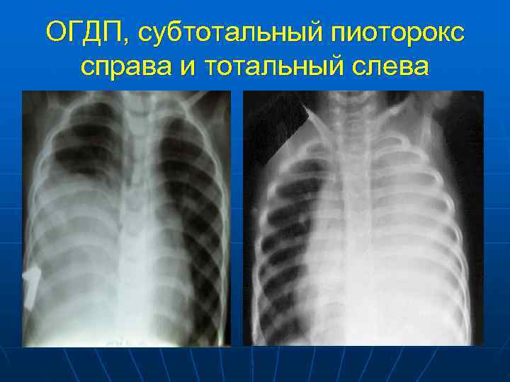ОГДП, субтотальный пиоторокс  справа и тотальный слева 