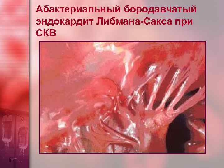 Абактериальный бородавчатый эндокардит Либмана-Сакса при СКВ 