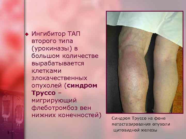 u Ингибитор ТАП второго типа (урокиназы) в большом количестве вырабатывается клетками злокачественных опухолей (синдром