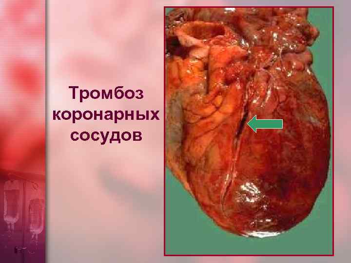 Тромбоз коронарных сосудов 