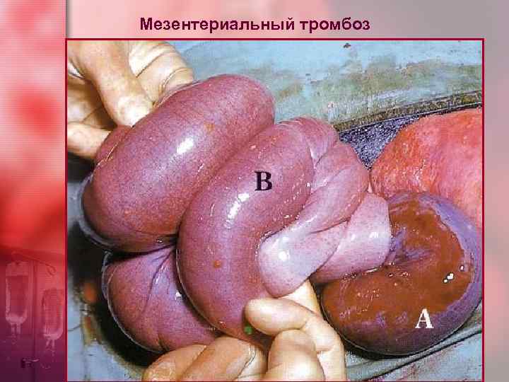 Мезентериальный тромбоз 