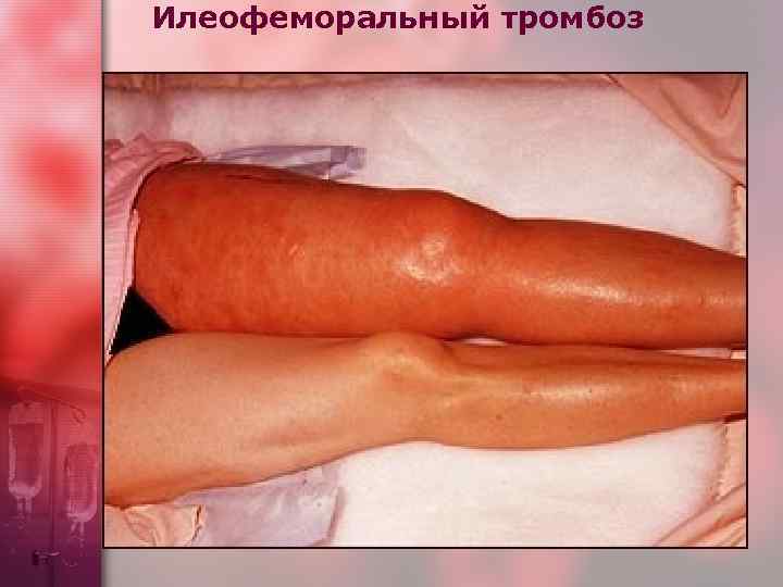 Илеофеморальный тромбоз 