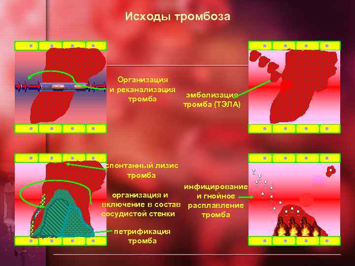 Исходы тромбоза Организация и реканализация тромба эмболизация тромба (ТЭЛА) спонтанный лизис тромба инфицирование организация