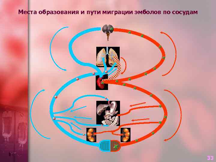 Места образования и пути миграции эмболов по сосудам 33 