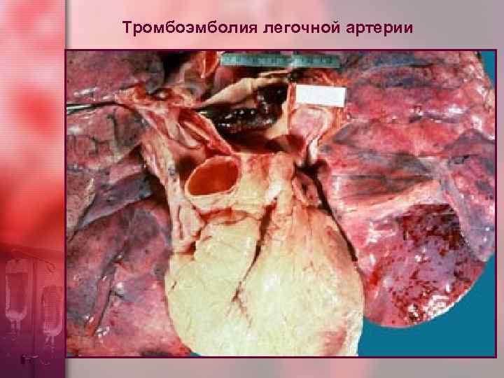 Тромбоэмболия легочной артерии 
