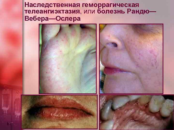 Наследственная геморрагическая телеангиэктазия, или болезнь Рандю— Вебера—Ослера 