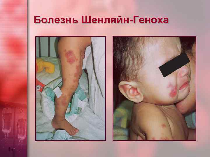 Болезнь Шенляйн-Геноха 