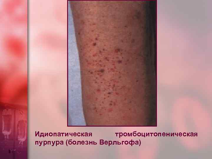 Идиопатическая тромбоцитопеническая пурпура (болезнь Верльгофа) 