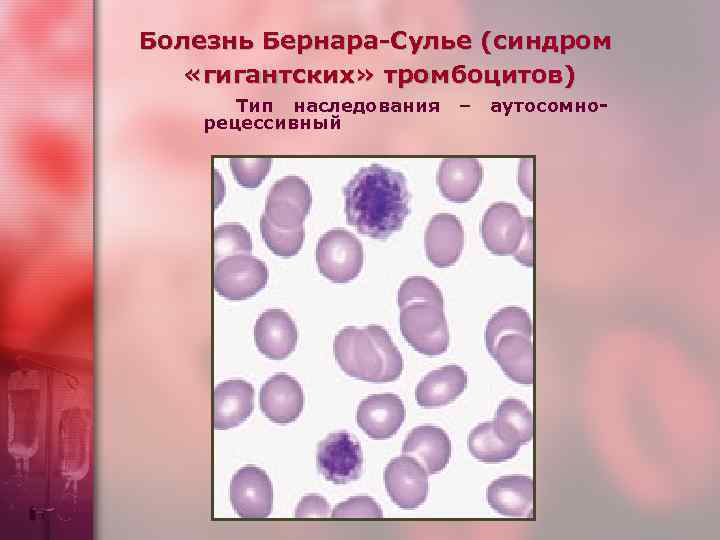 Болезнь Бернара-Сулье (синдром «гигантских» тромбоцитов) Тип наследования рецессивный – аутосомно- 