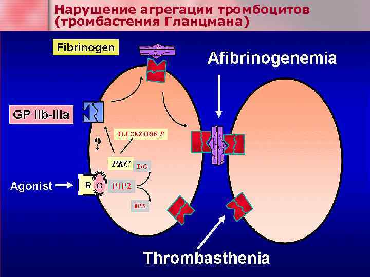 Нарушение агрегации тромбоцитов (тромбастения Гланцмана) 