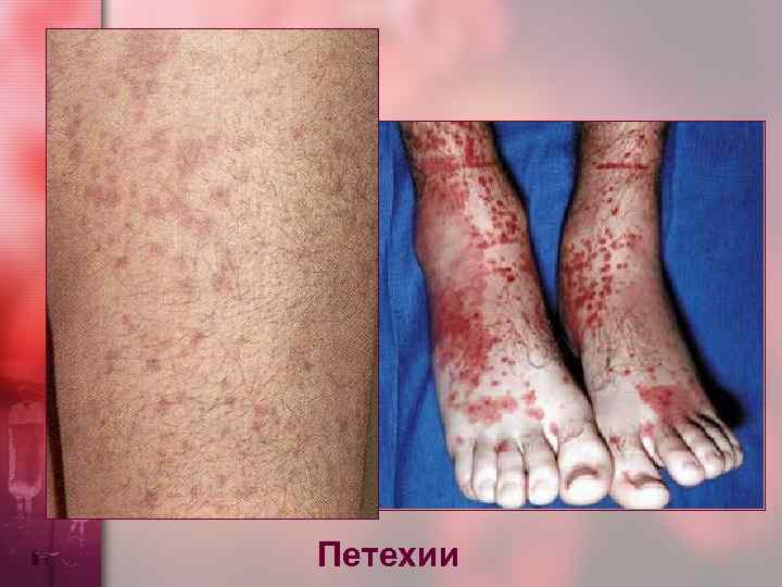 Петехии 