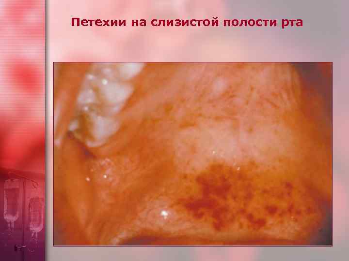 Петехии на слизистой полости рта Do not blanch with pressure (cf. angiomas) Not palpable