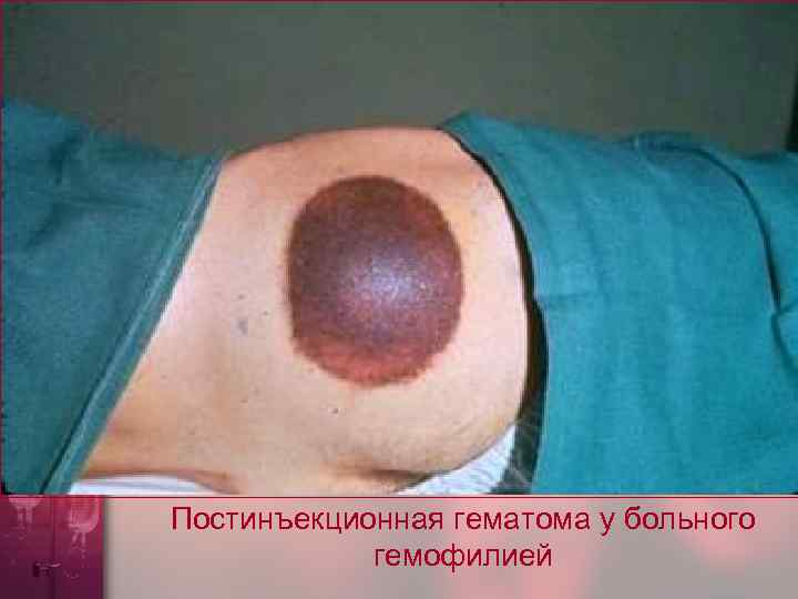 Постинъекционная гематома у больного гемофилией 