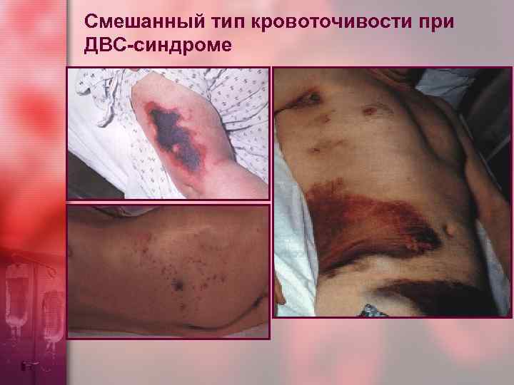 Смешанный тип кровоточивости при ДВС-синдроме 
