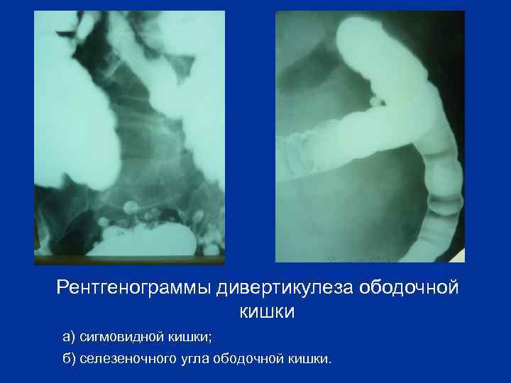 Рентгенограммы дивертикулеза ободочной     кишки  а) сигмовидной кишки; 