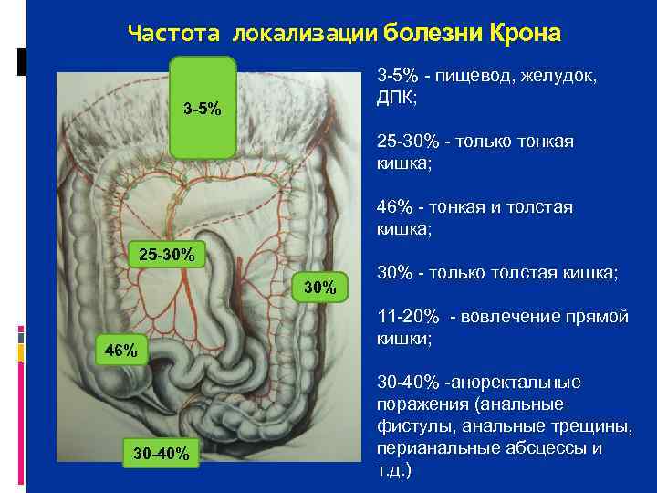  Частота локализации болезни Крона    3 5%  пищевод, желудок, 